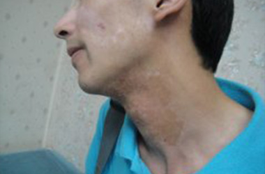 武汉患者脖子白癜风会给患者带来哪些危害?