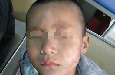 武汉白斑医院医生介绍儿童白癜风的病因